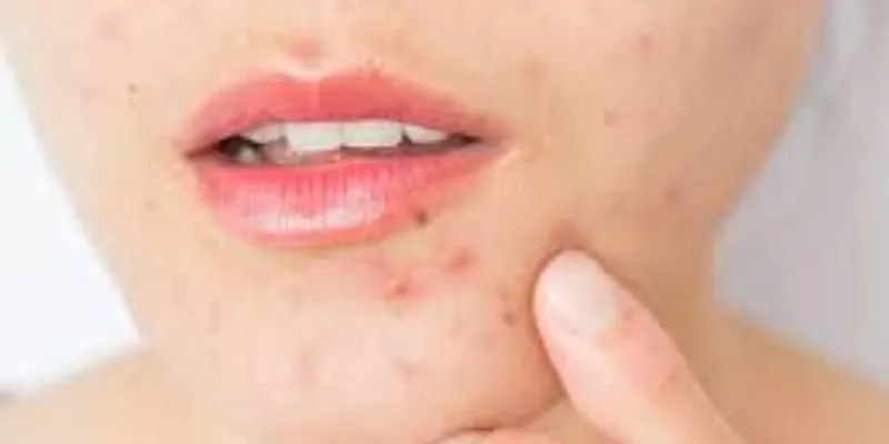 Trị dứt điểm mụn