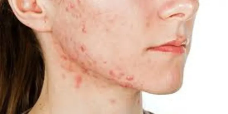 Trị dứt điểm mụn